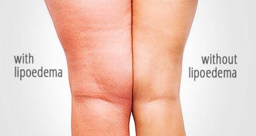 Lipedema symptoms