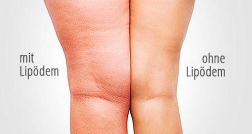 Lipedema symptoms